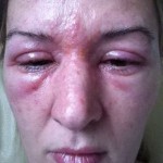 Alergická reakcia na lepidlo 3D riasy | dailymail.co.uk