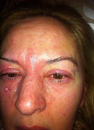 Jane Rolfe 3Dmihalnice alergická reakcia na lepidlo | dailymail.co.uk